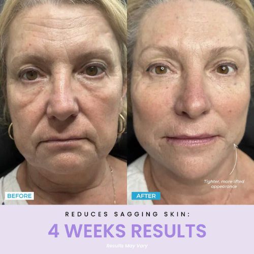 Sulmi®  LED Facial Facelift Tool