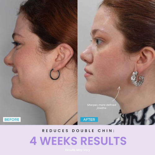 Sulmi®  LED Facial Facelift Tool
